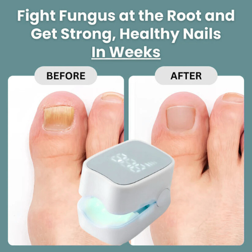 Swiftly™ - Nail Fungus Laser Device