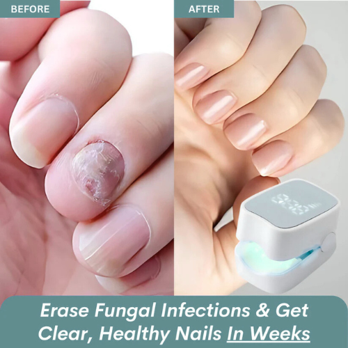 Swiftly™ - Nail Fungus Laser Device