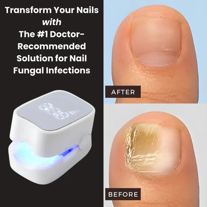 Swiftly™ - Nail Fungus Laser Device